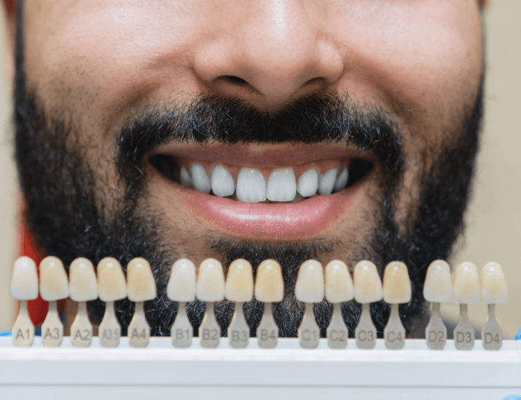 Professionelle Zahnaufhellung in Usak