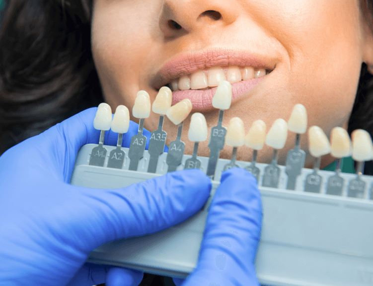 Vorteile eines sicheren Zähnebleichens in Usak