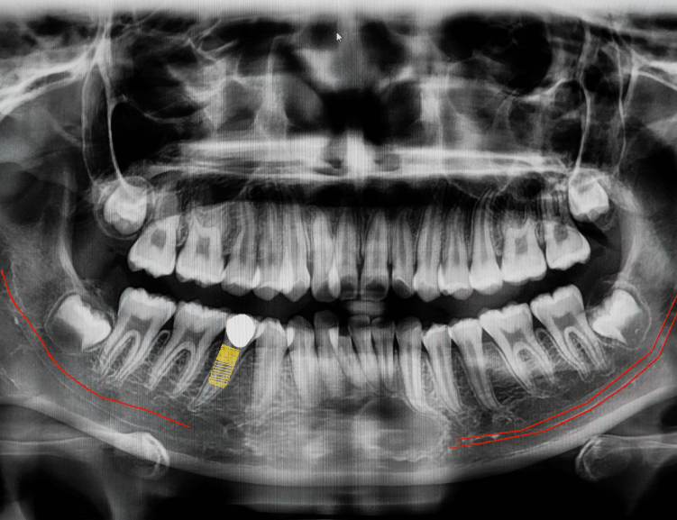 Fortschrittliche Techniken der Kieferoperation