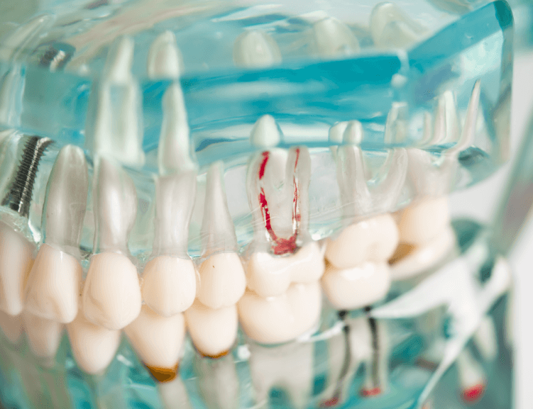 Fortschrittliche Wurzelkanaltechniken