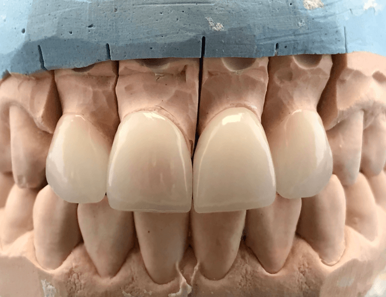 Zirkonium-Beschichtung in der Diva Zahnklinik